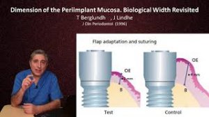 Мягкотканная интеграция имплантата (часть3)