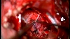 Удаление менингиомы мосто-мозжечкового угла