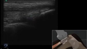 3D-пособие: ультразвуковое исследование сухожилия четырехглавой мышцы — SonoSite