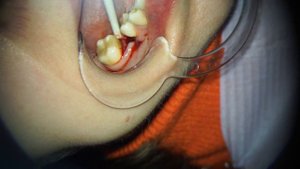 Установка имплантата Lenmiriot