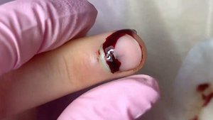 Прищемила палец?⚠️??? • ГЕМАТОМА