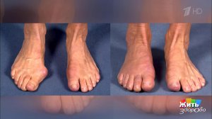 Косточка на пальце. Как лечить? Жить здорово! Фрагмент выпуска от 09.04.2019