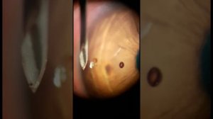 Инородное тело роговицы. RB clinic