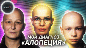 Страна лысых | АЛОПЕЦИЯ | Реальные истории о жизни без волос | #мынаты