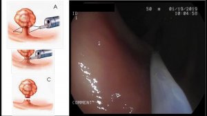 Удаление полипов в толстой кишке. Полипэктомия. Видеоколоноскопия в клинике Гиппократ