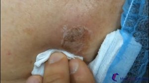 Удаление пигментного пятна 30 процентным ТСА пилингом