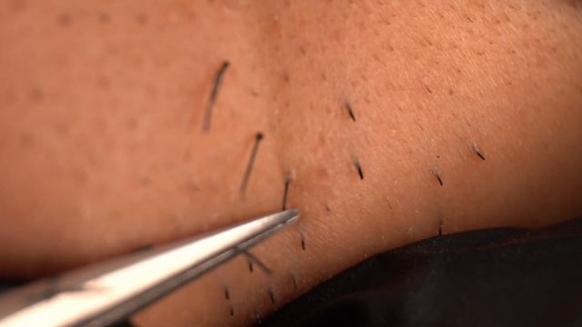 Вытяните нежелательные волосы щетиной с помощью пинцета【Удаление волос принцесс 20210427】