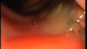 ЭРХПГ. Печеночная двуустка