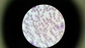 Лейкоцитарная формула. Серия три. #МонетныеСтолбикиЭритроцитов #гипохромияЭртроцитов