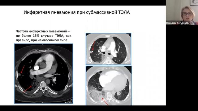 Рентгенологическая диагностика в КардиоБИТе Веселова Т.Н. смотреть онлайн