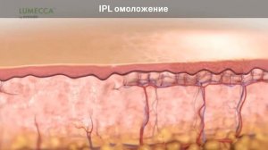 Фотоомоложение IPL: лечение пигментаци и купероза.