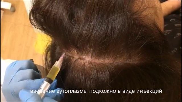 плазмолифтинг волос