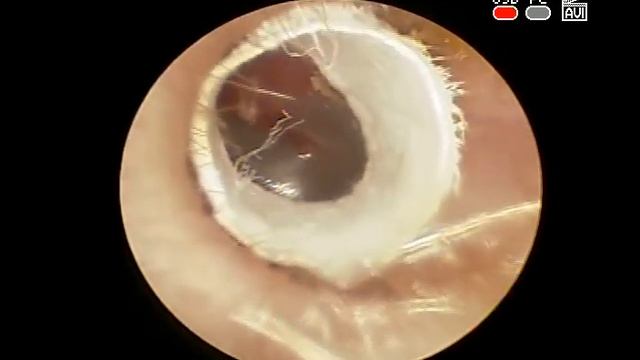 #Инородное тело наружного слухового #прохода #Видео 2 смотреть онлайн