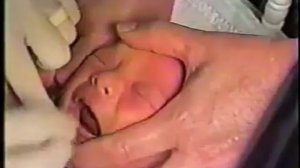 Пластика короткой уздечки языка новорожденного, Frenuloplastik