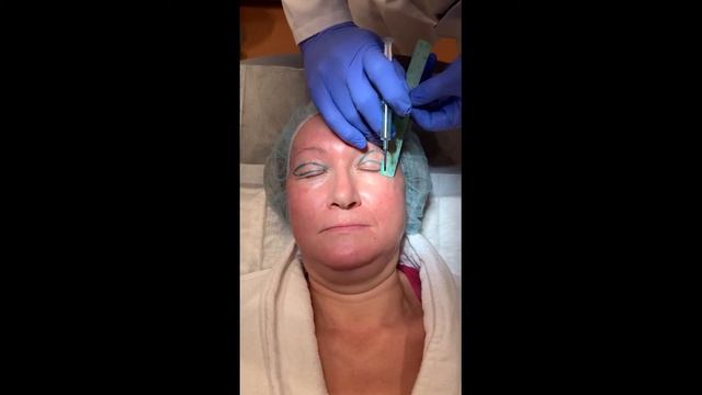 Разметка верхних век