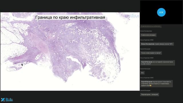 Веретеноклеточные опухоли молочной железы дифференциальный диагноз для патолога. Запись вебинара. смотреть онлайн