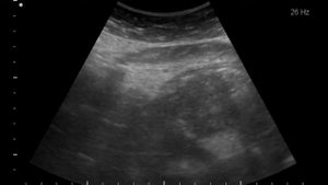 Cr антрального отдела желудка(3-12-17)