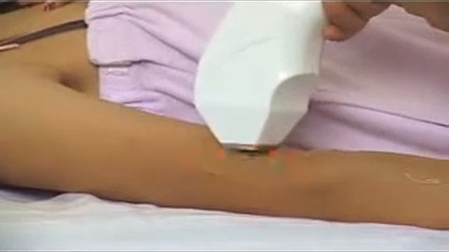 Diode laser hair removal system SD-1 смотреть онлайн