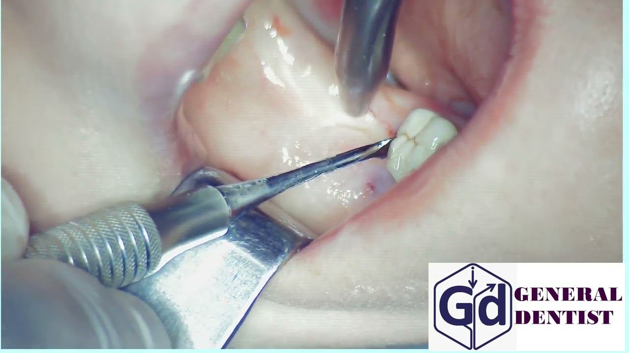 Technique detachment of the mucoperiosteal flap in area 47 for implantation.