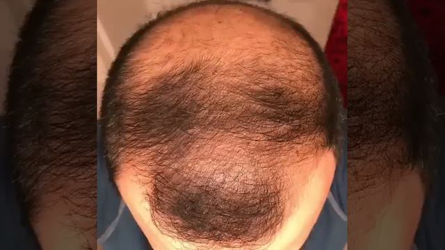 6 months using minoxidil - Rogaine 5 Before  After results