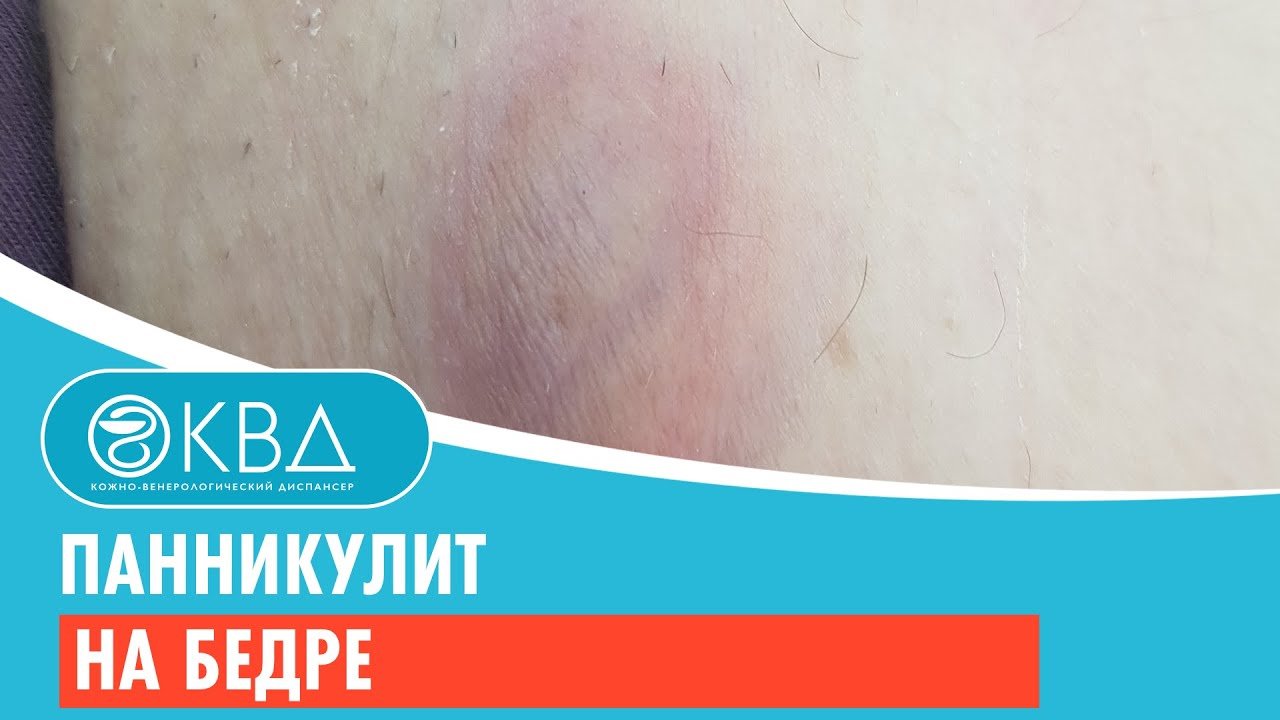 ? Панникулит на бедре. Клинический случай №256
