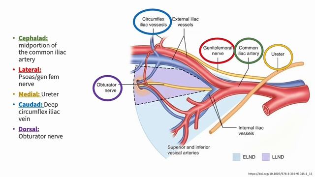 Pelvic and Paraaortic lymph node dissection смотреть онлайн