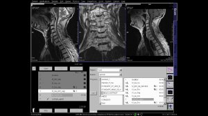 C spine MRI positioning +contrast enchanc