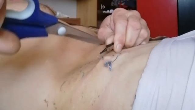 АППЕНДИЦИТ  швы