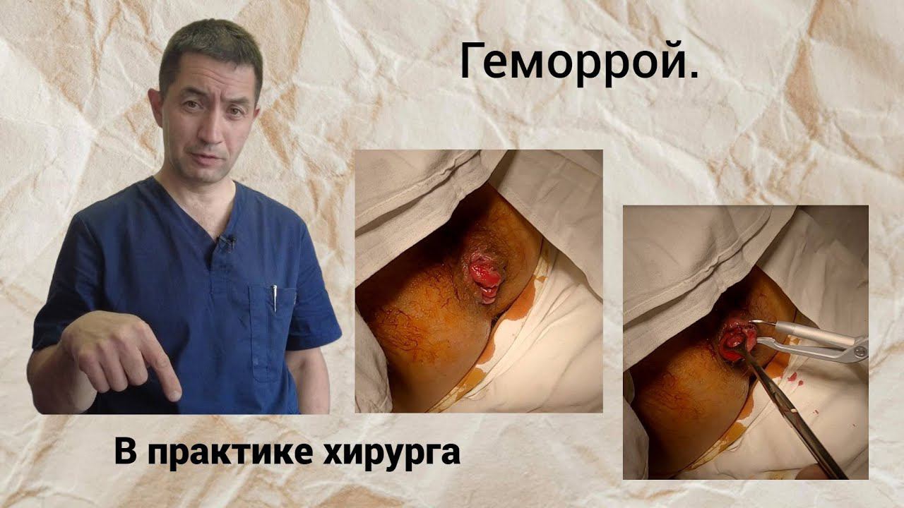 Геморрой. В практике хирурга.