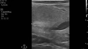 Образование головки поджелудочной железы.