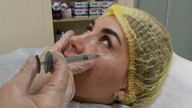 Инъекционная косметология. Заполнение носослезной борозды.