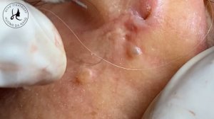 #257 | Huong Da Nang - Super Big Acne Part 2