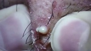 ✪ Blackhead Extraction | Acne Treatment | Pimples Popping #2