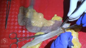 Формирование межкишечного анастомоза. Специально для СНК Эскулап