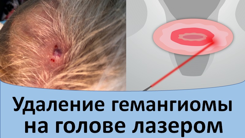 Удаление гемангиомы на голове лазером.