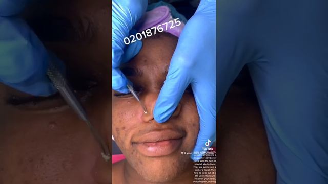 Acne black head extractions acne pimple removal #fyp #ghananews #ghana #viral