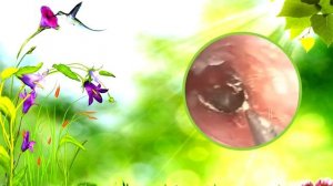 удаление воска уха с музыкой 02