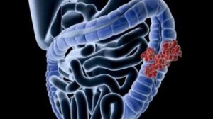 РАК ТОЛСТОЙ КИШКИ. Признаки того, что в Вашем теле растет РАК Толстой Кишки.