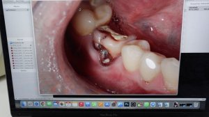 ЗУБ ИЛИ ИМПЛАНТ?