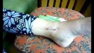 Гипс при переломе лодыжки  сняли,  прошло 9 дней начинаем вступать на ногу