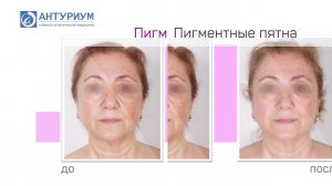 КЭМ Антуриум Кандела Нордлис