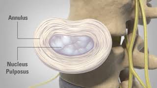 Discectomy Patient Education смотреть онлайн