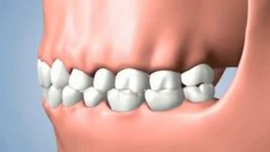 Проблемы связанные с потерей зуба