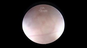 Полип полости матки. Современная методика удаления диодным лазером.