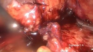 Ранение нижней полой вены