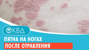 ?? Пятна на ногах после отравления. Клинический случай №818