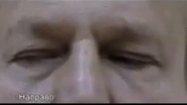 Энцефалопатия Вернике Корсакова