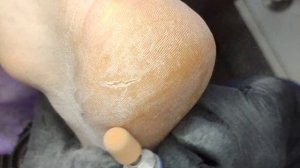ТРЕЩИНЫ НА ПЯТКАХ как правильно обрабатывать.Лечение трещин на ногах.Extremely Calloused Feet.修腳,腳趾