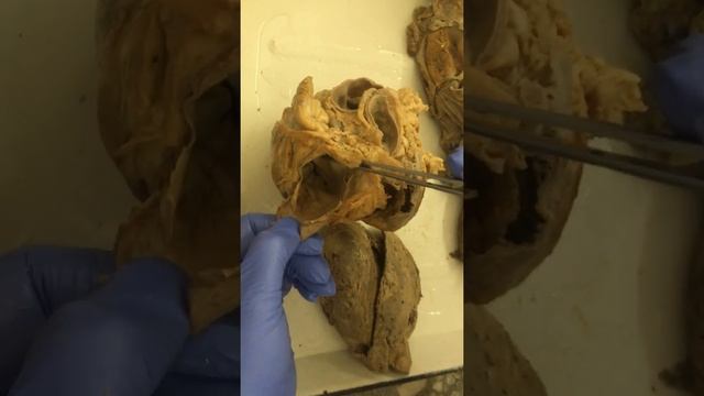 Сердце. Строение камер сердца. Клапаны сердца смотреть онлайн