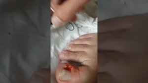 удаление вросшего ногтя на ноге в домашних условиях